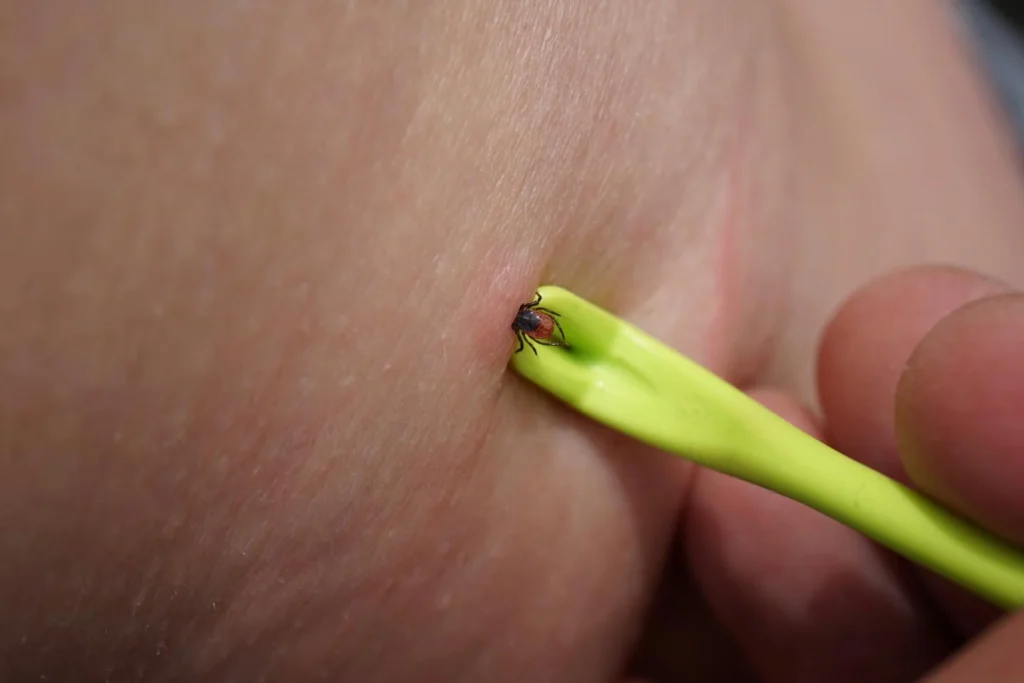 Removal of sucking tick ixodes ricinus from human skin with yellow tweezers